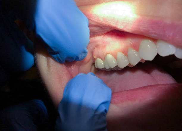 Best Emergency Treatment for Dental Infections or Abscesses in Mills, WY